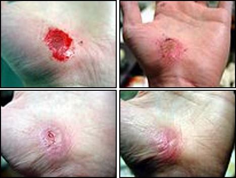 Clearing The Air About Moist Vs. Dry Wound Healing - TOPNURSE