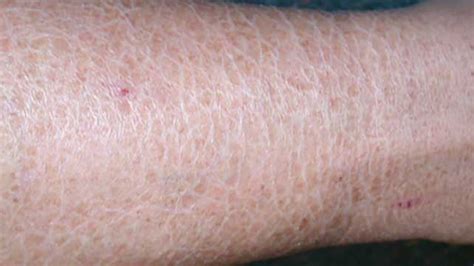 Eczema Soothing Cream, Itchy Rash, Baby Acne, Heat Rash, Scaly Skin, Dry Weeping Eczema ...