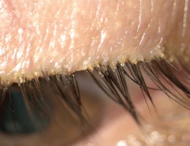 Demodex Blepharitis