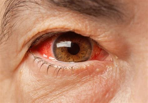 Everything You Need to Know About Glaucoma