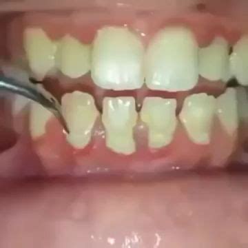 Full Mouth Debridement [Video] | Dental videos, Dental fillings, Dental hygiene school