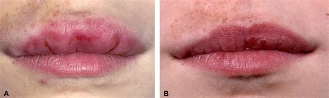 Cheilitis granulomatosa treated with intralesional corticosteroids and anti-inflammatory agents ...