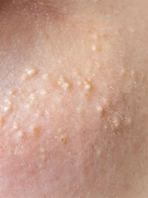 Whats That On Your Face Skin Bumps White Bumps On Face Skin Tag | Images and Photos finder