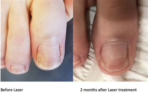 Fungal Nail Laser – Hugo Podiatry