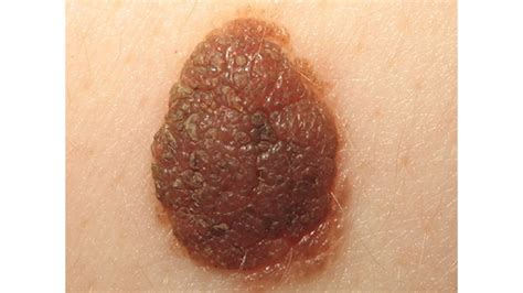 Superficial Spreading Melanoma - Net Health Book