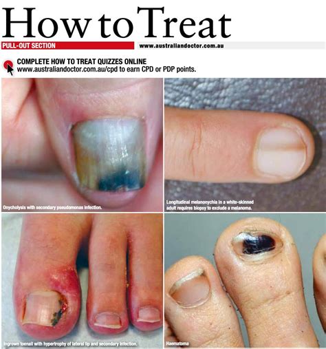 Ten Important Nail Disorders - Sinclair Dermatology