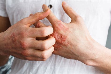 Diabetes and Skin Problems: Know About Diabetic Skin Disorder Causes ...