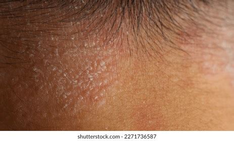 Psoriasis Skin Disease Causes Rash Itchy Stock Photo 2271736587 | Shutterstock