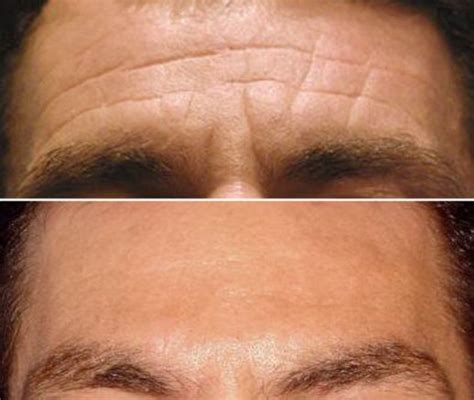 How To Remove Deep Wrinkles From Forehead Hot Sale | herv.be