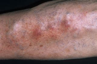 Phlebitis (superficial thrombophlebitis) - NHS