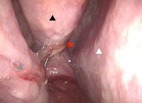 Sinoscopic examination revealed bloody mucoid nasal discharge (red ...