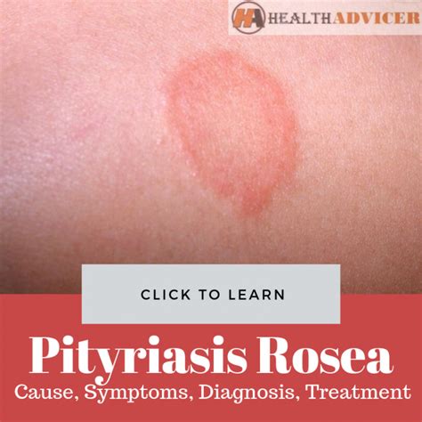 What Causes Pityriasis Rosea Rash