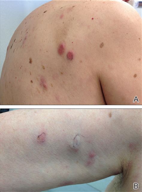 Primary Cutaneous Epstein-Barr Virus–Positive Diffuse Large B-Cell Lymphoma: A Rare and ...