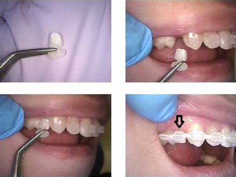 Complications in orthodontics and problems with braces