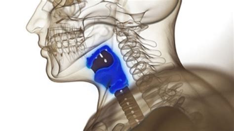 Artificial larynx implant helps throat cancer patient breathe and speak ...