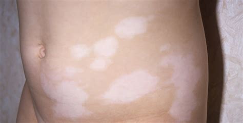 Pediatric Vitiligo: Look Beyond the Skin for Complete Treatment - Dermatology Advisor