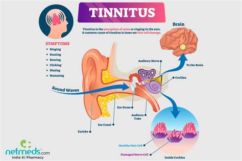 Tinnitus: Causes, Symptoms And Treatment