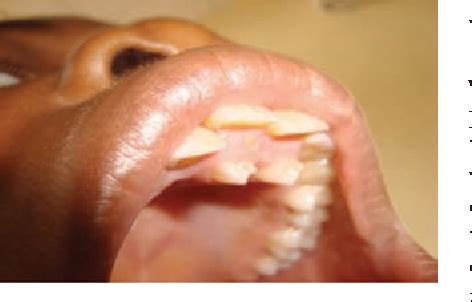 Figure 1 from Bilateral tuberculate supernumerary teeth | Semantic Scholar