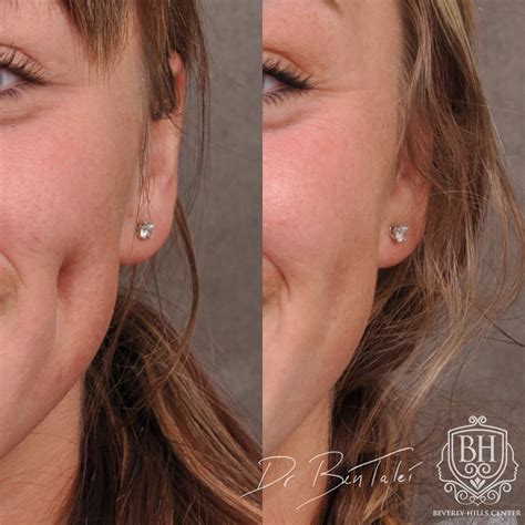 Scar, Piercing & Mole Removal – Before & Afters | Beverly Hills Center