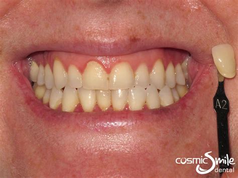 Zoom teeth whitening vs laser - lasinet