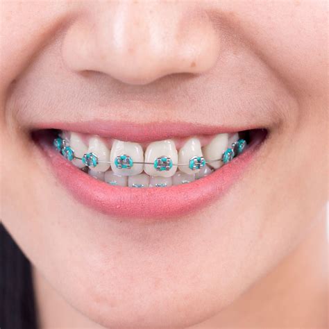Types of Dental Retainers to Wear After Braces | Clear Retainers near ...