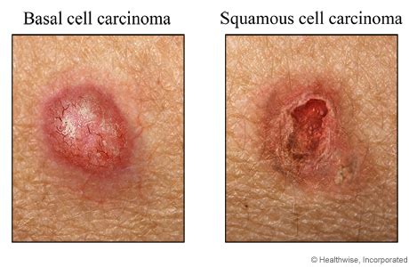 Basal and squamous cell carcinoma | Cigna