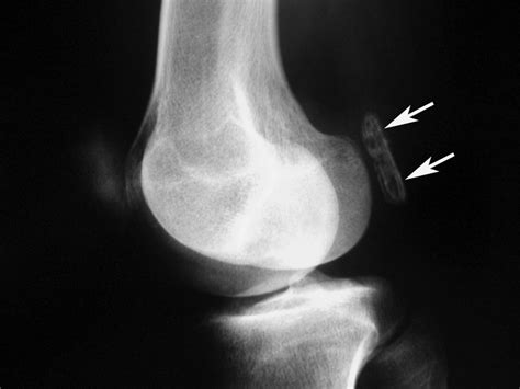 Symptomatic enlarged fabella -- Agathangelidis et al. 2016 -- BMJ Case ...