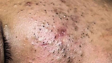 POPPING BLACKHEADS ON FACE [NEWEST BLACKHEADS VIDEOS 2021] - YouTube