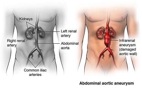 Abdominal Aortic Aneuysm | SFVVG