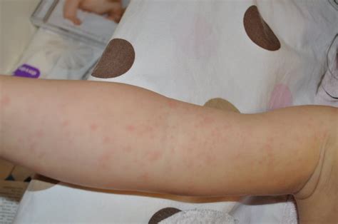 Baby Rash Pictures, Causes, Treatments | Baby pictures, Pictures, Baby