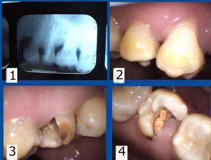 Tooth decay seen in x-rays and photos–