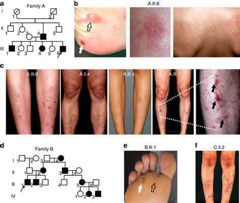 Pedigrees and clinical presentation of the patients with epidermolysis ...