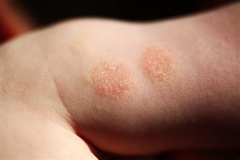 Mild Nummular Eczema