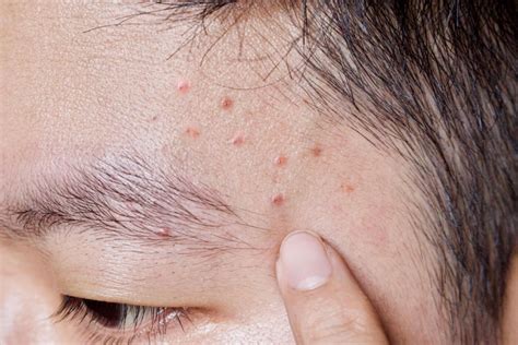 8 reasons you may have little bumps on your face