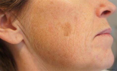 How To Remove Age Spots? - Dermatologist in Roorkee