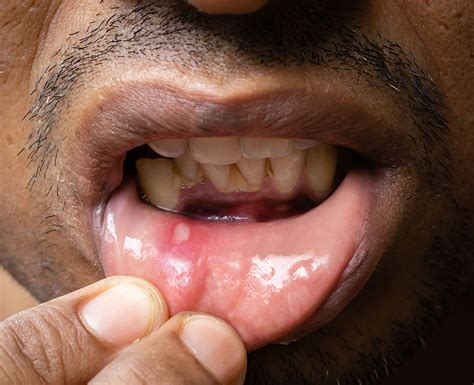 Mouth Ulcers: Types, Causes & Treatment