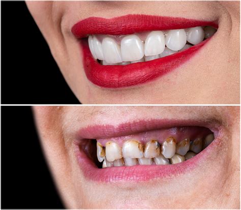 Porcelain Crowns vs. Veneers: Choosing the Right Smile Solution