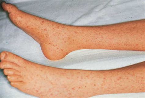 HealthoolRickettsial Pox Rash Pictures Atlas of Rashes Associated With Fever Rocky Mountain ...