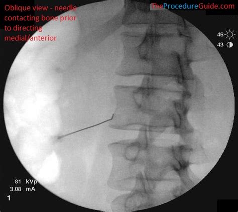 Lumbar Sympathetic Block - Technique and Overview - The Procedure Guide