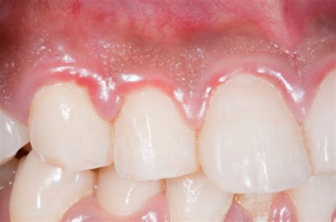 Bright & Dark Red Gums: Its Causes And Treatment | OraMD