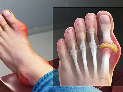 Is Gout the Cause of My Toe Pain?