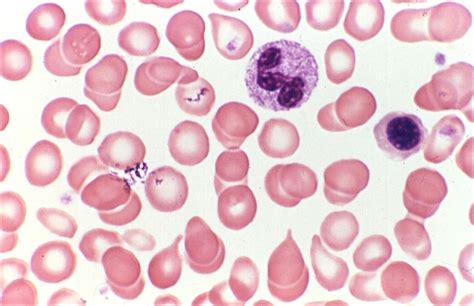 Pancytopenia in a 67-Year-Old Female – Lablogatory