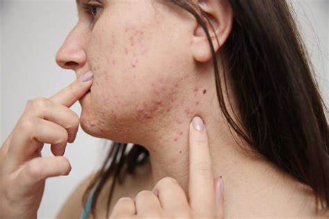 Itchy acne can be very annoying, check out how to soothe it!