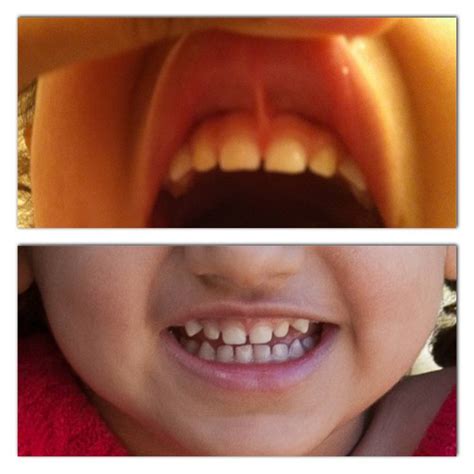 Discovering And Correcting Lip Tie On A Toddler And An Infant