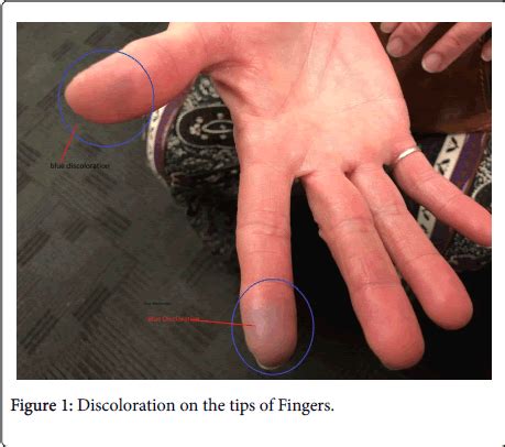 internal-medicine-tips-Fingers