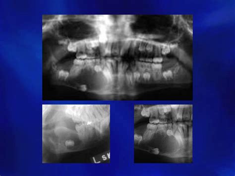 Odontogenic cysts