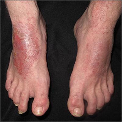 Red patches and thin plaques on feet | MDedge Family Medicine