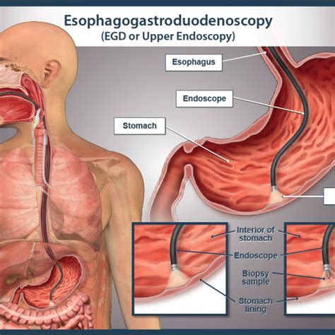 Upper GI Endoscopy - drchetankalal