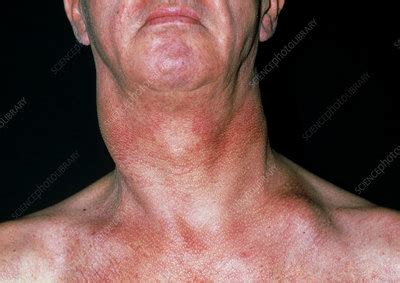 Cancer of lymph node - Stock Image - M131/0395 - Science Photo Library