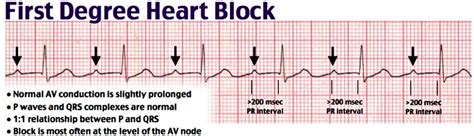 Heart block causes, symptoms, types, diagnosis and heart block treatment